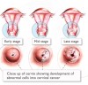 Hpv